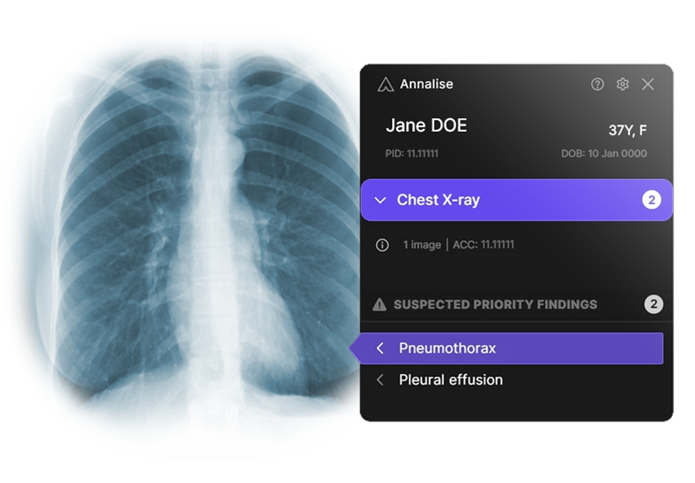 Annalise.ai Launches AI-Powered Worklist Triage for Chest X-Ray & Head CTs
