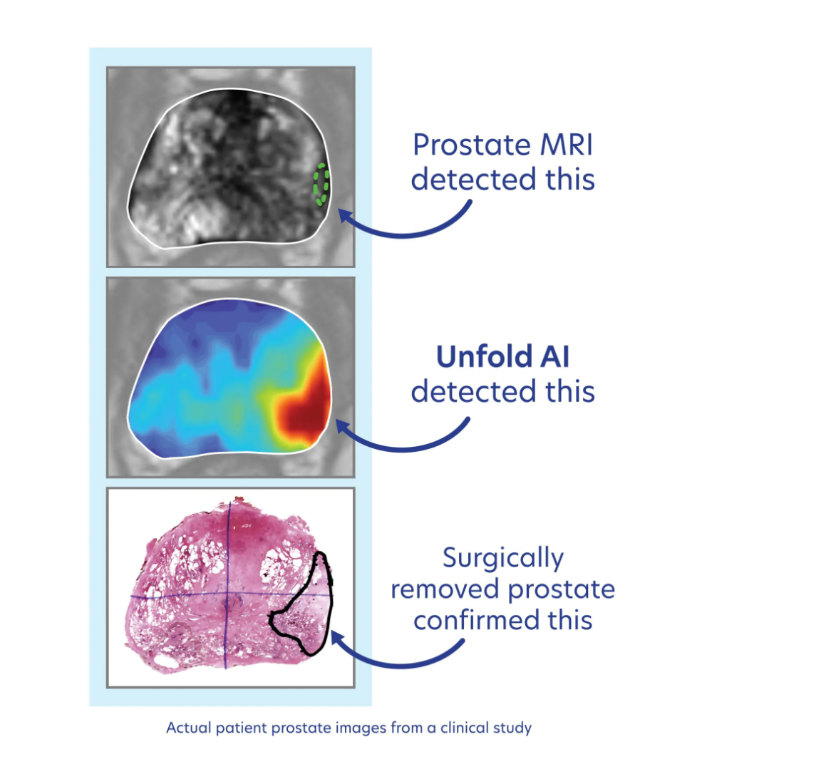 First CPT Code for AI Prostate Cancer Imaging Issued for Avenda Health